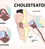 Ear-cholesteatoma