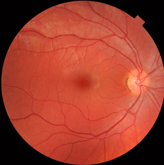 Retina Treatment