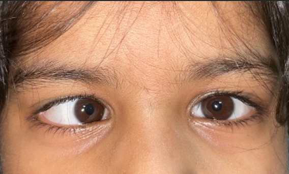 Strabismus Treatment