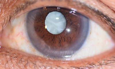 cataract-1