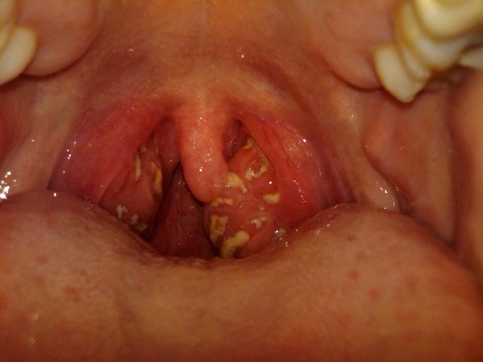 chronic-tonsillitis-2