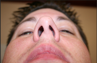 Deviated Nasal Septum