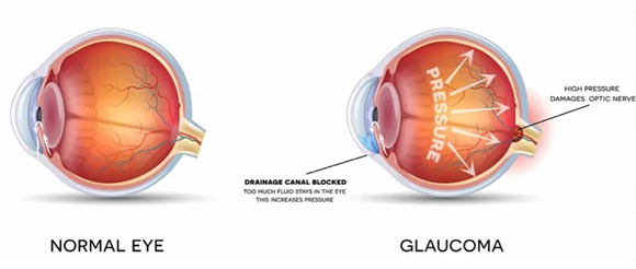 glaucoma-2