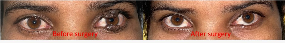 oculoplasty-3
