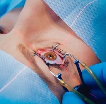 refractive-surgery-1