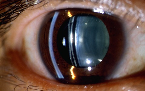 refractive-surgery-2