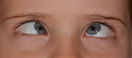 refractive-surgery-1